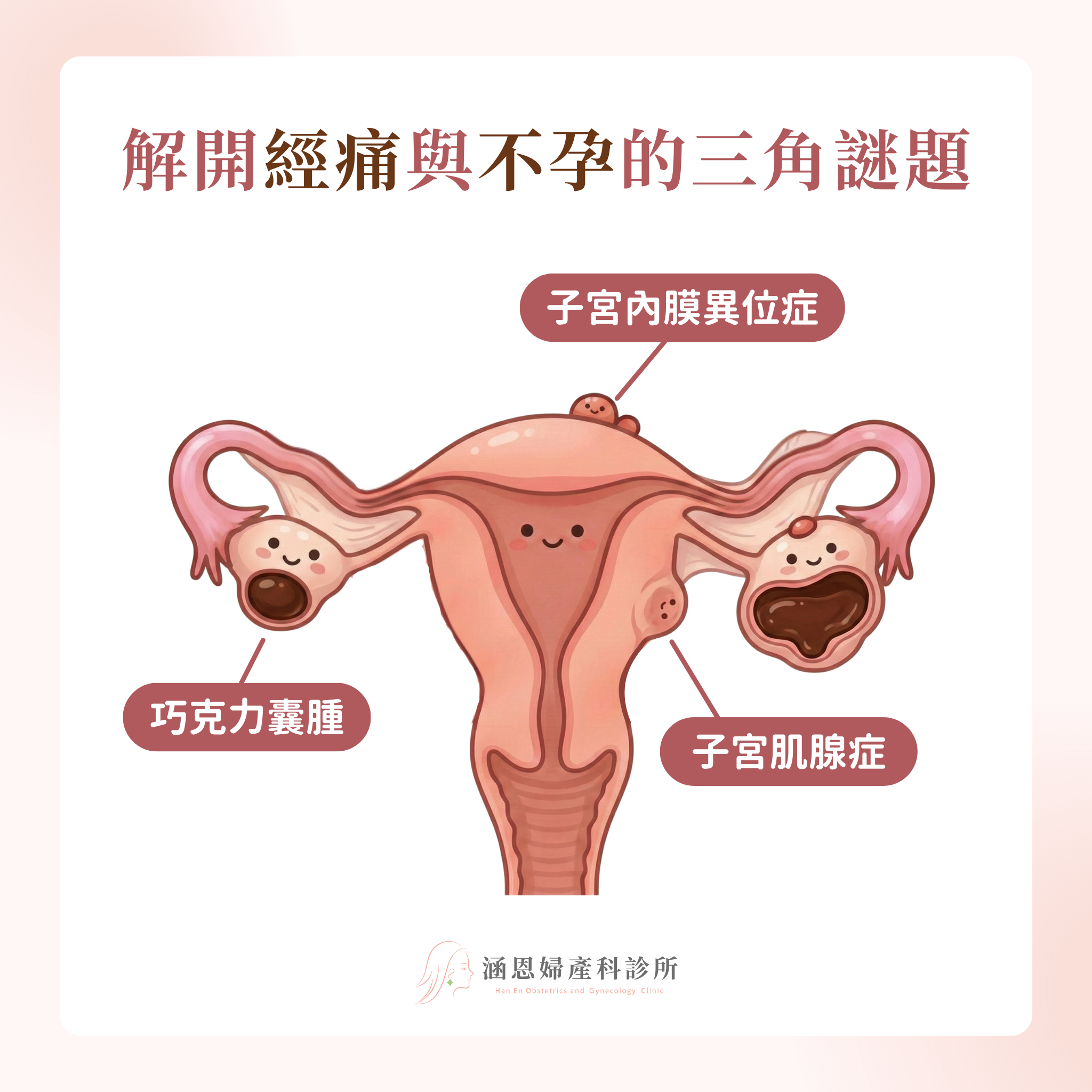 解析子宮內膜異位症、子宮肌腺症與巧克力囊腫如何引發女性嚴重經痛與不孕的三角謎題